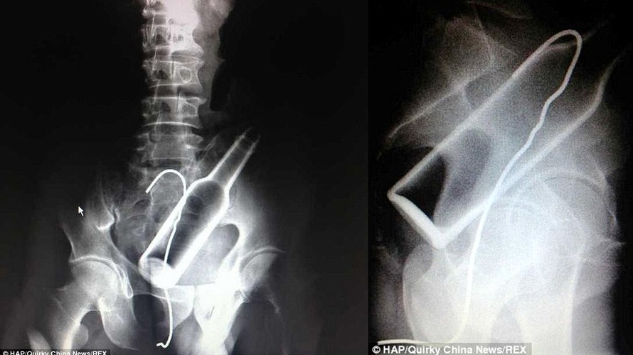 Hình ảnh chụp X-quang tại bệnh Viện Phúc Châu có thể thấy rõ cái chai và một đoạn dây thép trong bụng